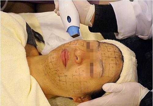 電波拉皮治療怎么樣才有效？